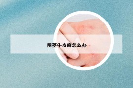 陰莖牛皮癬怎么辦