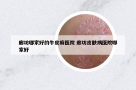 廊坊哪家好的牛皮癬醫(yī)院 廊坊皮膚病醫(yī)院哪家好