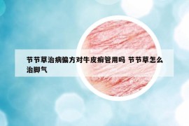節(jié)節(jié)草治病偏方對牛皮癬管用嗎 節(jié)節(jié)草怎么治腳氣
