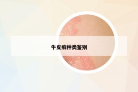 牛皮癬種類鑒別