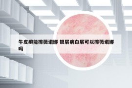 牛皮癬能擦薇諾娜 銀屑病白屑可以擦薇諾娜嗎