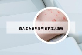 古人怎么治銀屑病 古代怎么治癬