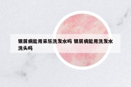 銀屑病能用采樂洗發(fā)水嗎 銀屑病能用洗發(fā)水洗頭嗎