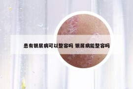患有銀屑病可以整容嗎 銀屑病能整容嗎