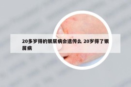 20多歲得的銀屑病會遺傳么 20歲得了銀屑病