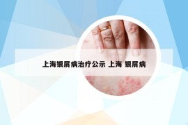上海銀屑病治療公示 上海 銀屑病