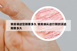 銀屑病進型期要多久 銀屑病從進行期到消退期要多久