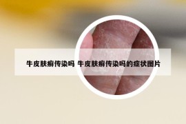 牛皮膚癬傳染嗎 牛皮膚癬傳染嗎的癥狀圖片