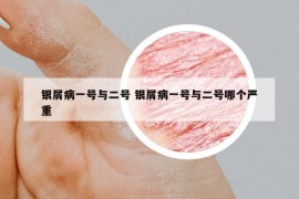 銀屑病一號與二號 銀屑病一號與二號哪個嚴重