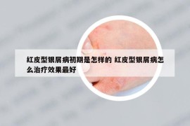 紅皮型銀屑病初期是怎樣的 紅皮型銀屑病怎么治療效果最好