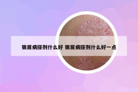 銀屑病搽劑什么好 銀屑病搽劑什么好一點(diǎn)