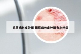 銀屑病包皮外面 銀屑病包皮外面有小疙瘩