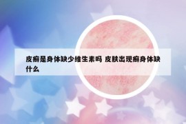 皮癬是身體缺少維生素嗎 皮膚出現(xiàn)癬身體缺什么