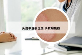 頭皮牛皮癬流血 頭皮癬出血