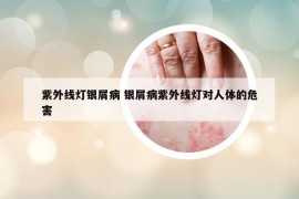 紫外線燈銀屑病 銀屑病紫外線燈對人體的危害