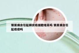 銀屑病會引起鱗狀癌細(xì)胞增高嗎 銀屑病會引起癌癥嗎