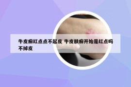 牛皮癬紅點點不起皮 牛皮膚癬開始是紅點嗎不掉皮