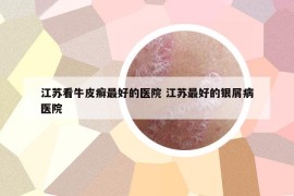 江蘇看牛皮癬最好的醫(yī)院 江蘇最好的銀屑病醫(yī)院