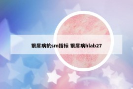 銀屑病抗sm指標(biāo) 銀屑病hlab27