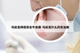 馬應(yīng)龍痔瘡膏去牛皮癬 馬應(yīng)龍什么藥膏治癬