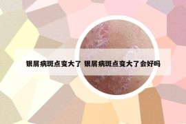 銀屑病斑點(diǎn)變大了 銀屑病斑點(diǎn)變大了會(huì)好嗎