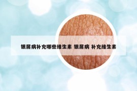 銀屑病補充哪些維生素 銀屑病 補充維生素