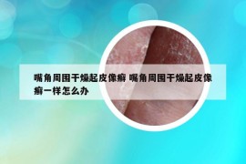嘴角周圍干燥起皮像癬 嘴角周圍干燥起皮像癬一樣怎么辦
