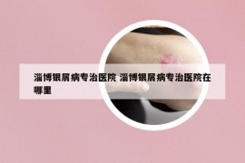淄博銀屑病專(zhuān)治醫(yī)院 淄博銀屑病專(zhuān)治醫(yī)院在哪里
