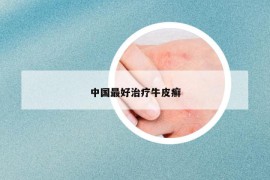 中國(guó)最好治療牛皮癬