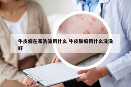 牛皮癬在家洗澡用什么 牛皮膚癬用什么洗澡好