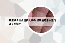 銀屑病母親會(huì)遺傳兒子嗎 銀屑病母親會(huì)遺傳兒子嗎知乎