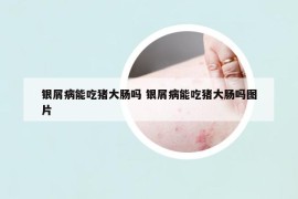 銀屑病能吃豬大腸嗎 銀屑病能吃豬大腸嗎圖片