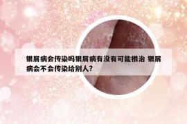 銀屑病會傳染嗎銀屑病有沒有可能根治 銀屑病會不會傳染給別人?