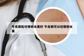 牛皮癬能吃哪些水果好 牛皮癬可以吃哪些水果