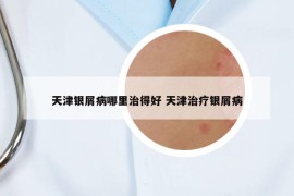 天津銀屑病哪里治得好 天津治療銀屑病
