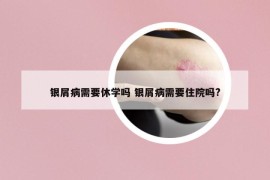 銀屑病需要休學(xué)嗎 銀屑病需要住院?jiǎn)?
