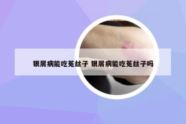 銀屑病能吃菟絲子 銀屑病能吃菟絲子嗎