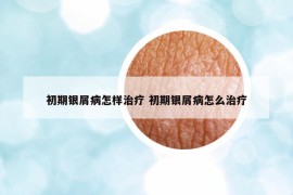 初期銀屑病怎樣治療 初期銀屑病怎么治療