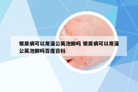 銀屑病可以用蒲公英泡腳嗎 銀屑病可以用蒲公英泡腳嗎百度百科