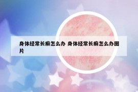 身體經(jīng)常長(zhǎng)癬怎么辦 身體經(jīng)常長(zhǎng)癬怎么辦圖片
