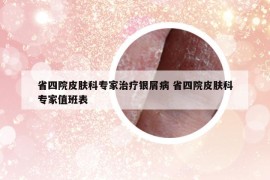 省四院皮膚科專家治療銀屑病 省四院皮膚科專家值班表