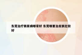 東莞治療銀屑病哪家好 東莞哪里治皮膚比較好