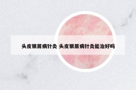 頭皮銀屑病針灸 頭皮銀屑病針灸能治好嗎