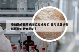 貴陽治療銀屑病哪家權威專家 貴陽銀屑病?？漆t(yī)院在什么地方?