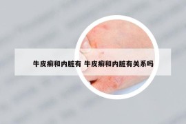 牛皮癬和內(nèi)臟有 牛皮癬和內(nèi)臟有關(guān)系嗎