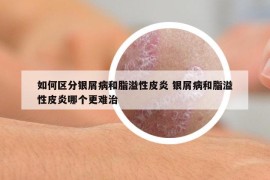 如何區(qū)分銀屑病和脂溢性皮炎 銀屑病和脂溢性皮炎哪個更難治