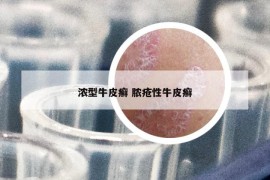 濃型牛皮癬 膿瘡性牛皮癬
