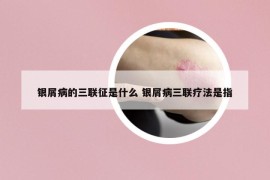 銀屑病的三聯(lián)征是什么 銀屑病三聯(lián)療法是指