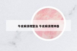 牛皮癬清理整治 牛皮癬清理神器