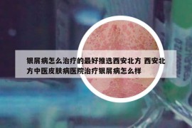 銀屑病怎么治療的最好推選西安北方 西安北方中醫(yī)皮膚病醫(yī)院治療銀屑病怎么樣